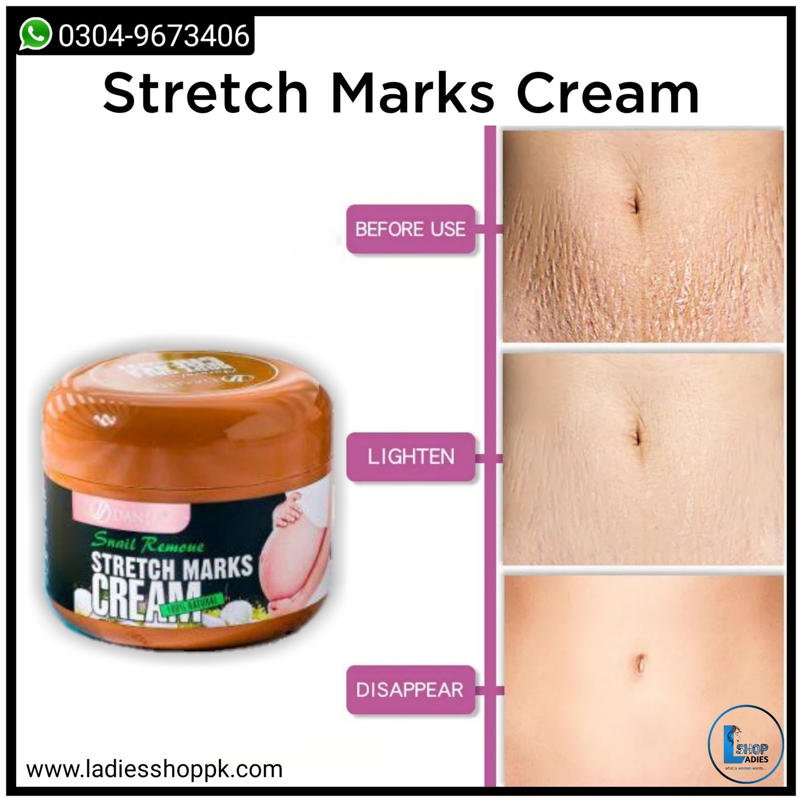 cream to reduce stretch marks